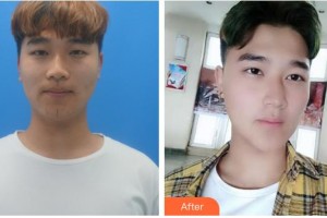 荊州市婦幼保健院眼科杜東成整形價(jià)格表附切開雙眼皮案例展示