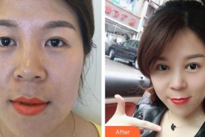 荊州市婦幼保健院眼科駱駿整形價(jià)格表附切開雙眼皮案例展示
