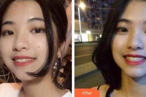 荊州公安縣楚星口腔門診胡歡歡整形價(jià)格表附牙齒隱形矯正案例展示