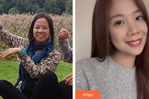 黃岡皓雅口腔醫(yī)院馮杰整形價(jià)格表附金屬托槽矯正案例展示