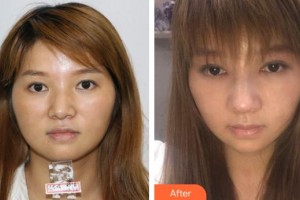 隨州艾琳醫(yī)療美容診所艾琳整形價(jià)格表附假體隆鼻案例展示