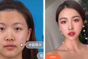 隨州真愛(ài)整形美容醫(yī)院高成整形價(jià)格表附鼻部綜合案例展示