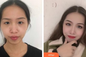 隨州愛(ài)爾眼科醫(yī)院江霞整形價(jià)格表附眼部綜合案例展示