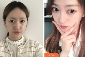 咸寧奧萊醫(yī)療美容門診部陳鷲整形價(jià)格表附熱瑪吉案例展示