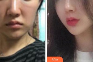 咸寧安美醫(yī)療美容門診部余默聲整形價(jià)格表附埋線提升案例展示
