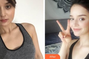 孝感華美醫(yī)療美容門診部王志軍整形價(jià)格表附埋線提升案例展示