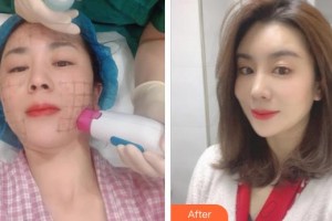 孝感仁愛醫(yī)院美容整形中心王悅整形價(jià)格表附熱瑪吉案例展示