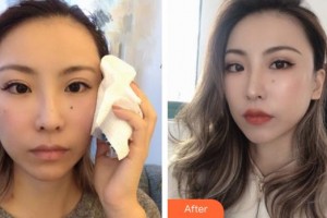 孝感仁愛醫(yī)院美容整形中心金日炫整形價(jià)格表附埋線提升案例展示