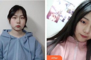 孝感現(xiàn)代儷人醫(yī)院整形科王婷整形價格表附埋線提升案例展示