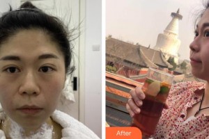孝感歐陽整形美容診所王珺整形價格表附熱瑪吉案例展示