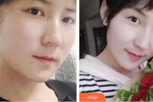 孝感華美醫(yī)療美容門診部黃露整形價格表附埋線提升案例展示