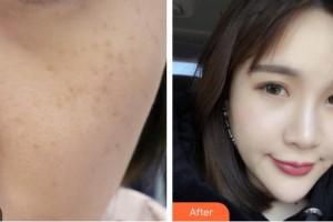 孝感緣臨美容整形醫(yī)院鄧妮整形價格表附激光美膚激光案例展示