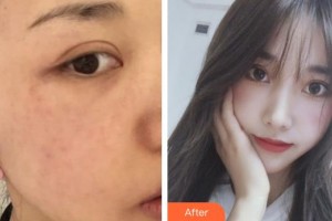 孝感仁愛醫(yī)院美容整形中心涂忠駿整形價格表附激光美膚激光案例展示