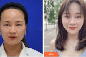 孝感現(xiàn)代儷人醫(yī)院整形科杜家杰整形價格表附埋線提升案例展示