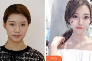 孝感天妃醫(yī)療美容門診部柳肖整形價格表附埋線提升例展示