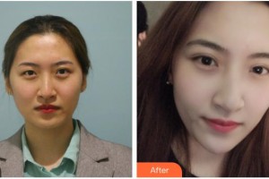 孝感愛爾眼科醫(yī)院桂芬整形價格表附埋線雙眼皮案例展示