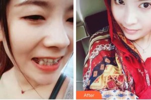 孝感愛爾眼科醫(yī)院李川輝整形價格表附切開雙眼皮案例展示