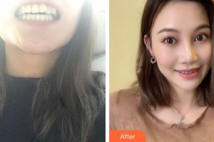 孝感植貝爾口腔門診部王悟君整形價格表附牙齒隱形矯正案例展示