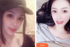 鄂州中山口腔醫(yī)院李駿整形價(jià)格表附牙齒隱形矯正案例展示