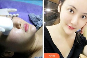武漢艾格眼科醫(yī)院彭毅整形價格表附激光去眼袋案例展示