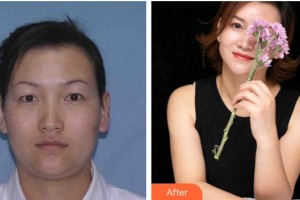 武漢艾格眼科醫(yī)院偉整形價格表附眼部綜合案例展示