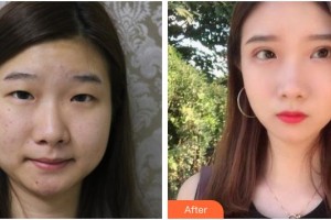 武漢艾格眼科醫(yī)院張?jiān)接⒄蝺r格表附切開雙眼皮案例展示