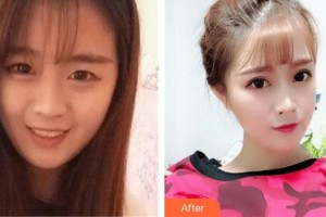 武漢艾格眼科醫(yī)院高天整形價格表附切開雙眼皮案例展示