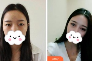 武漢艾格眼科醫(yī)院雷澄整形價格表附眼部綜合案例展示