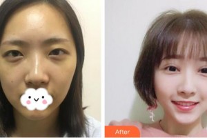 武漢艾格眼科醫(yī)院劉艷春整形價格表附切開雙眼皮案例展示