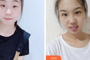 武漢佰視達(dá)眼科門診部顧兢兢整形價格表附切開雙眼皮案例展示