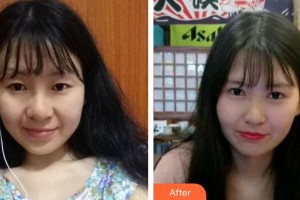 武漢佰視達(dá)眼科門診部張鑫整形價格表附切開雙眼皮案例展示