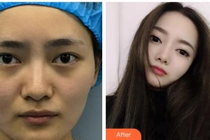 武漢佰視達(dá)眼科門(mén)診部趙青華整形價(jià)格表附眼部修復(fù)案例展示