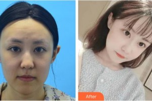 黃石市中心醫(yī)院整形外科王政祥整形價格表附埋線提升案例展示
