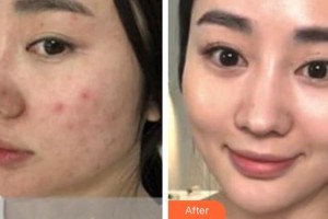 黃石華中?？滇t(yī)院（華中.華美）張智珍整形價(jià)格表附黃金微針案例展示