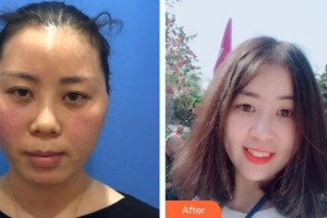 黃石美亞醫(yī)療美容門診部張明雙整形價格表附埋線提升案例展示