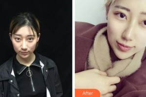 黃石華中?？滇t(yī)院（華中.華美）余秋芬整形價(jià)格表附埋線提升案例展示