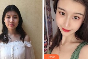 十堰海菲醫(yī)學(xué)美容診所劉海燕整形價(jià)格表附埋線提升案例展示