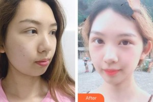 十堰阿芙羅醫(yī)療整形美容門(mén)診部林平珍整形價(jià)格表附埋線提升案例展示