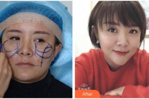 十堰東慧醫(yī)療美容門(mén)診部曾祥蘭整形價(jià)格表附埋線提升案例展示