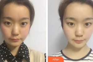十堰市婦幼保健院整形美容中心陳紅梅整形價(jià)格表附埋線提升案例展示