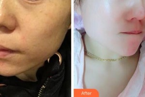 十堰阿芙羅醫(yī)療整形美容門(mén)診部陳敬斌整形價(jià)格表附激光美膚激光案例展示