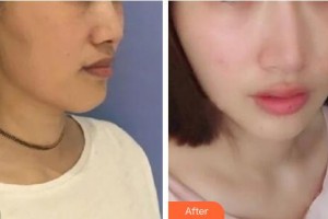 十堰市婦幼保健院整形美容中心蹇洪整形價(jià)格表附射頻緊膚案例展示
