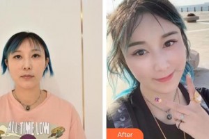 十堰東慧醫(yī)療美容門(mén)診部余建軍整形價(jià)格表附埋線提升案例展示