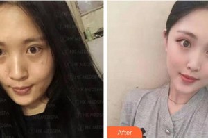 十堰太和醫(yī)院整形美容中心呂娟整形價(jià)格表附埋線提升案例展示