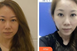 十堰市人民醫(yī)院整形美容燒傷外科陸華整形價(jià)格表附埋線提升案例展示