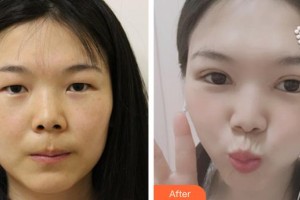 十堰愛(ài)爾眼科醫(yī)院黃濤整形價(jià)格表附眼部綜合案例展示