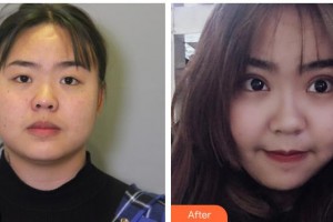 十堰愛(ài)爾眼科醫(yī)院張守奇整形價(jià)格表附眼部綜合案例展示