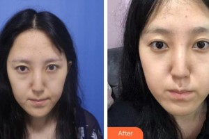 十堰愛(ài)爾眼科醫(yī)院楊永清整形價(jià)格表附激光去眼袋案例展示