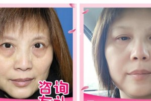 十堰愛(ài)爾眼科醫(yī)院鄭瑞整形價(jià)格表附激光去眼袋案例展示