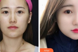 襄陽華美醫(yī)療美容門診部羅定安整形價(jià)格表附去痘印痘坑案例展示